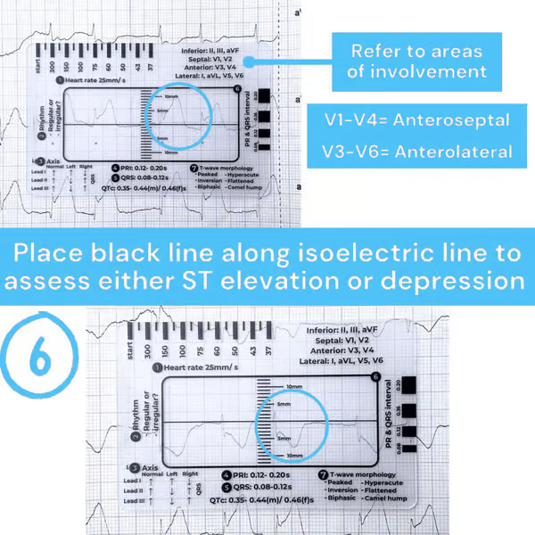 🔥HOT SALE -ECG 7 Step Ruler